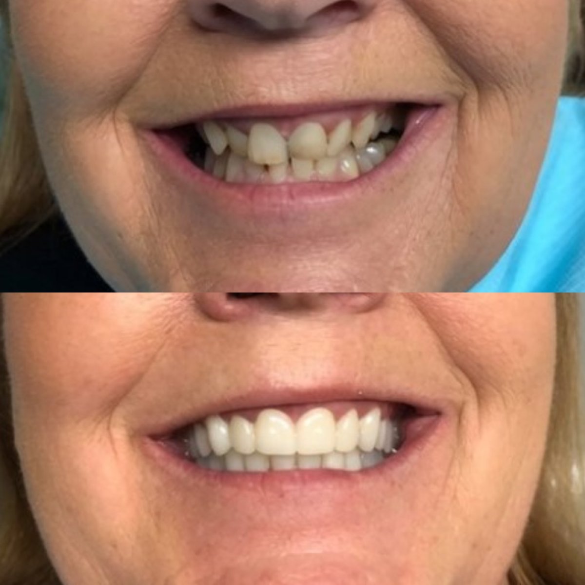 Vorher-nachher-Ergebnis Hollywood Smile bei CIVICO DENTAL CARE MEXICALI, Lächeln-Transformation