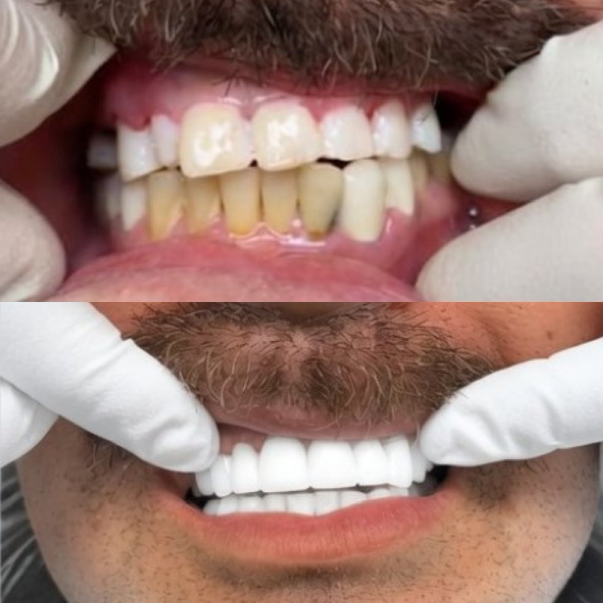 نتائج قبل وبعد ابتسامة هوليود في CIVICO DENTAL CARE MEXICALI، تحول الابتسامة