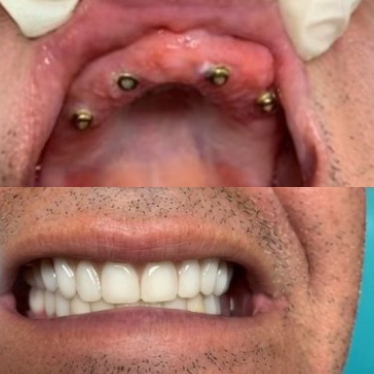 نتيجة قبل وبعد زراعة الأسنان All-on-6 في CIVICO DENTAL CARE MEXICALI، ابتسامة مستعادة