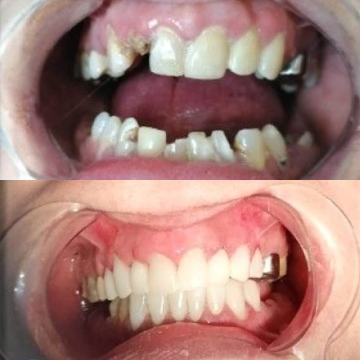 Before and after dental implant results at CIVICO DENTAL CARE MEXICALI, restored smile transformation