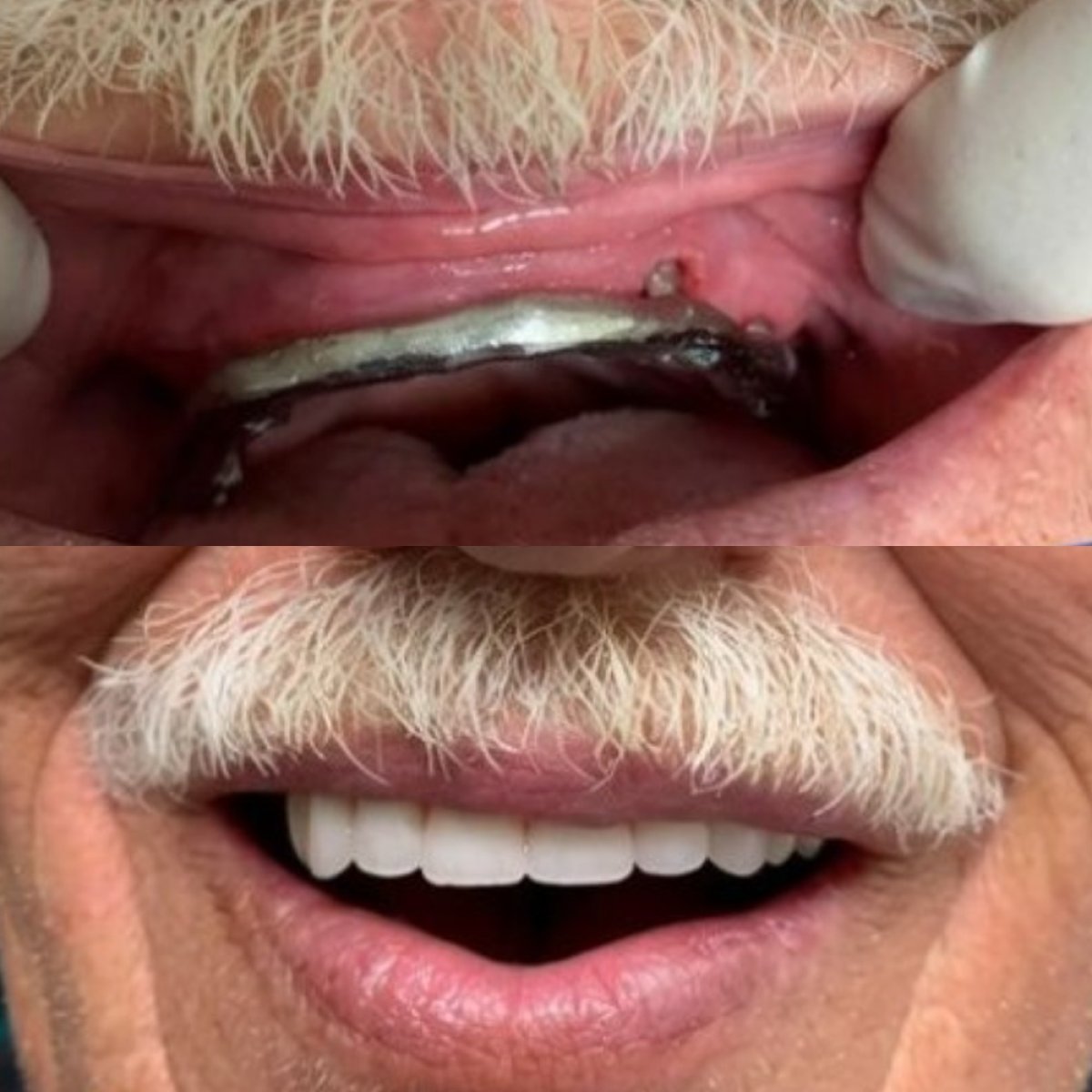 Результаты до и после имплантации зубов в CIVICO DENTAL CARE MEXICALI, восстановленная улыбка