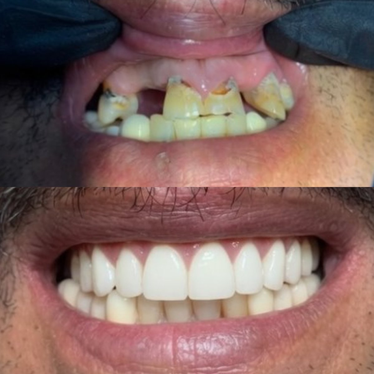 Vorher-nachher-Ergebnis Zahnprothese bei CIVICO DENTAL CARE MEXICALI, neues Lächeln