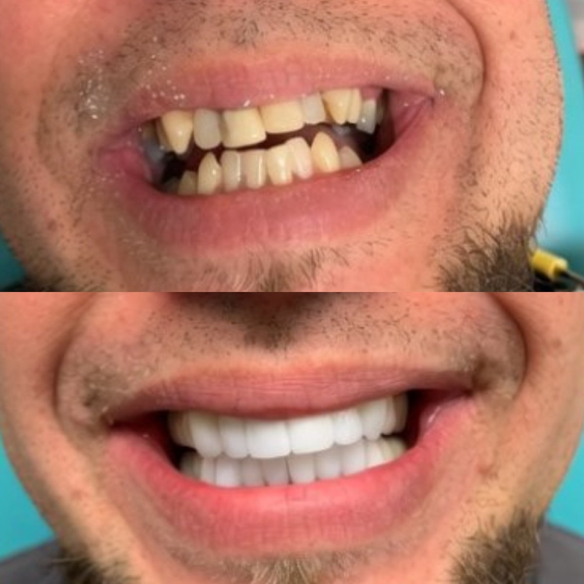 Vorher-nachher-Ergebnis Zahnprothese bei CIVICO DENTAL CARE MEXICALI – verbesserte Smile