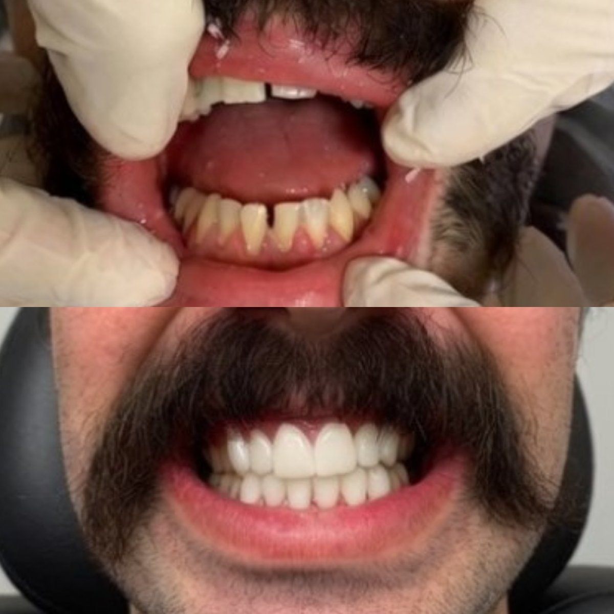 Résultats avant et après prothèse dentaire chez CIVICO DENTAL CARE MEXICALI, sourire amélioré