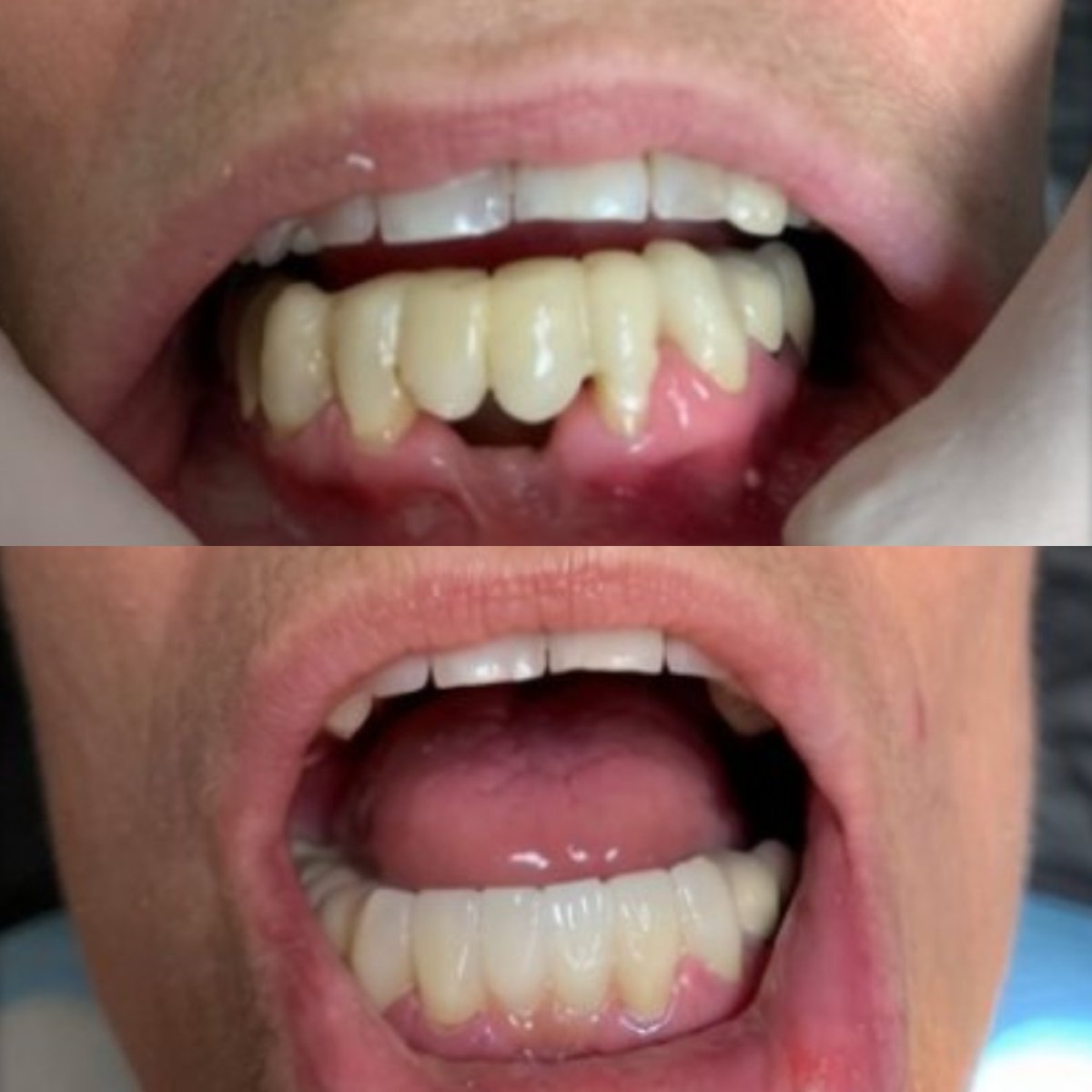 نتائج طقم الأسنان قبل وبعد في CIVICO DENTAL CARE MEXICALI – استعادة الابتسامة