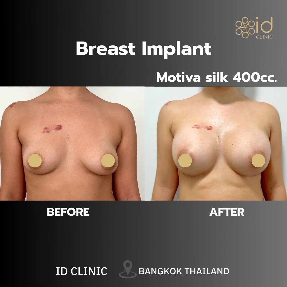Before and after breast augmentation with Motiva 400cc implants at ID Clinic Bangkok results