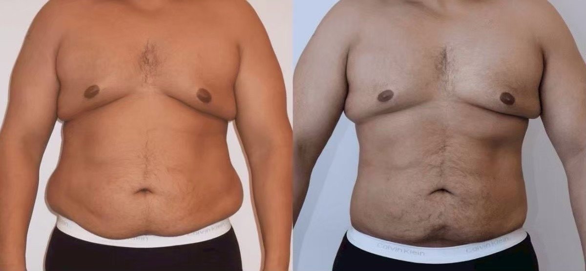 Before and after Vaser liposuction results at Somchai Clinic – visible abdominal fat reduction