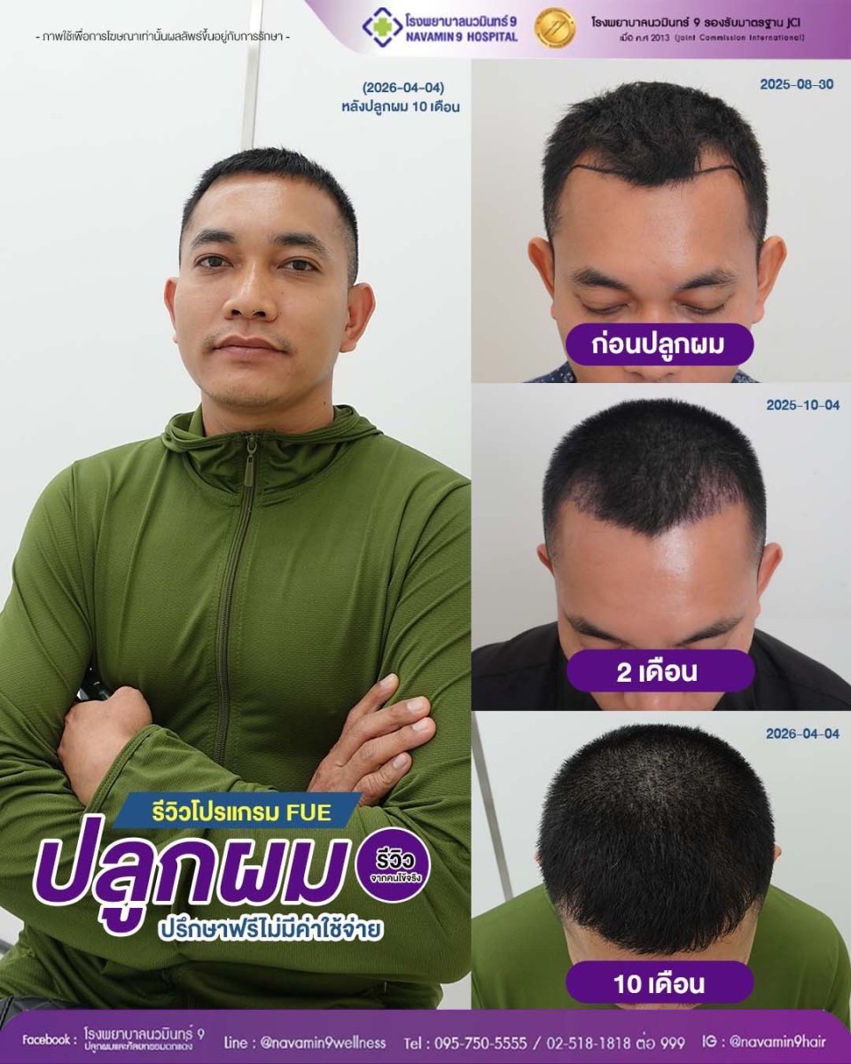 Résultats avant et après greffe de cheveux FUE au Department of Skin & Surgery - NAVAMIN9 HOSPITAL