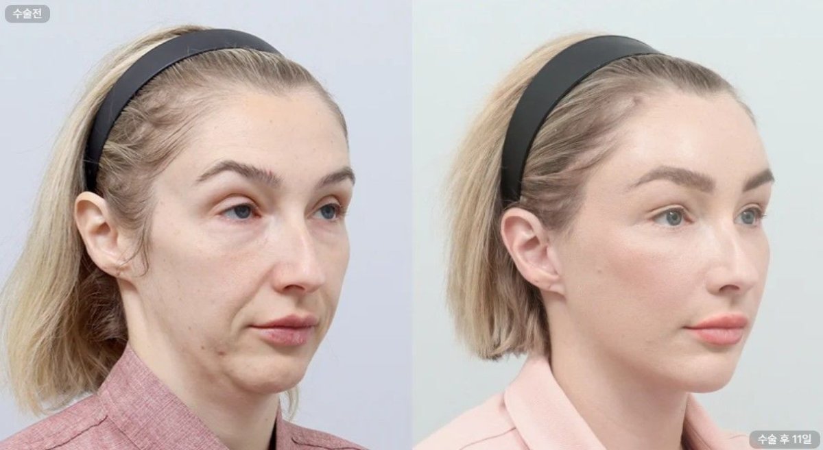نتائج شد الوجه قبل وبعد في AB Plastic Surgery – تجديد شباب الوجه بشكل واضح