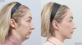 Fotos vor und nach Facelift durch Dr. Inho Bae