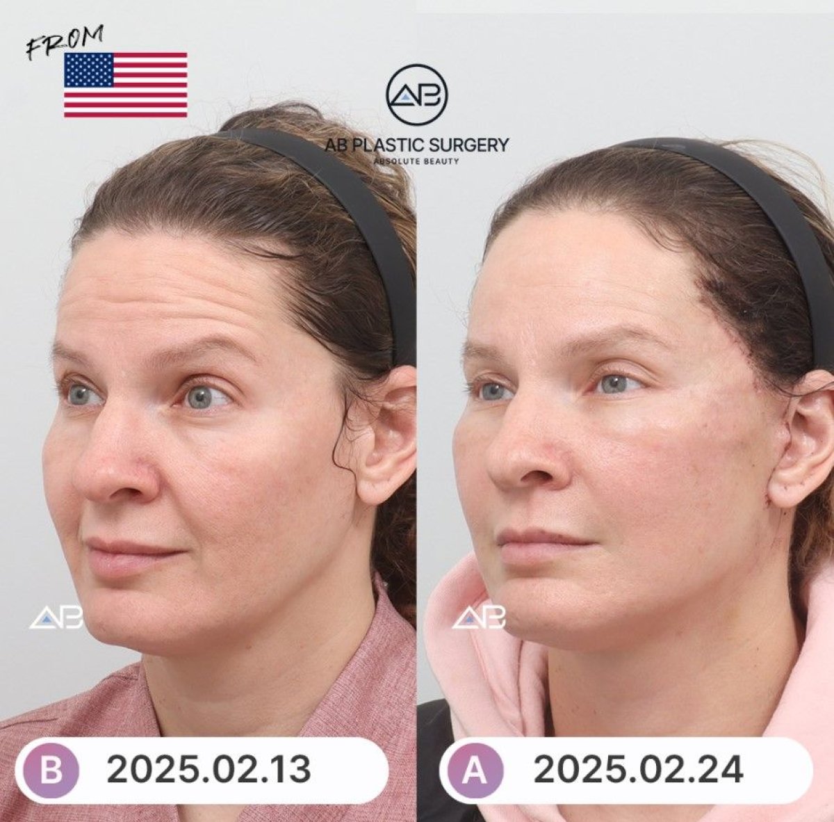 Résultats avant et après lifting du visage chez AB Plastic Surgery – rajeunissement visible