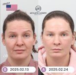 Fotos vor und nach Facelift durch Dr. Inho Bae