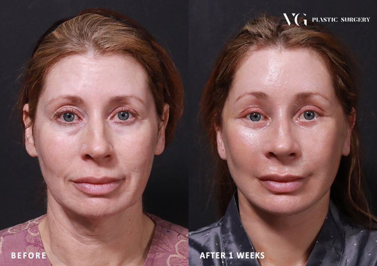 Результаты до и после Ultherapy в VG Plastic Surgery – видимый лифтинг кожи лица