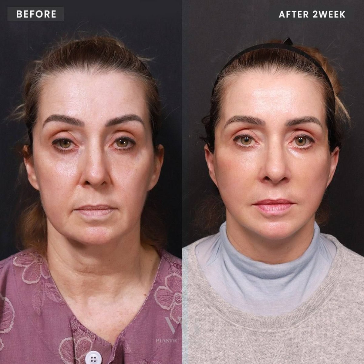 Результаты до и после Ultherapy в VG Plastic Surgery, видимый лифтинг кожи лица