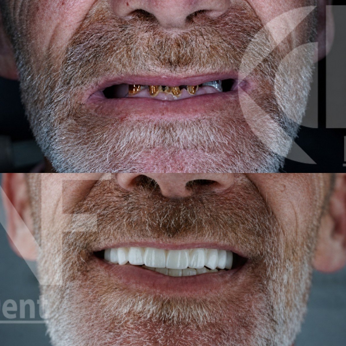Before and after Hybrid All-on-6 implant denture results at Nifa Dent International clinic