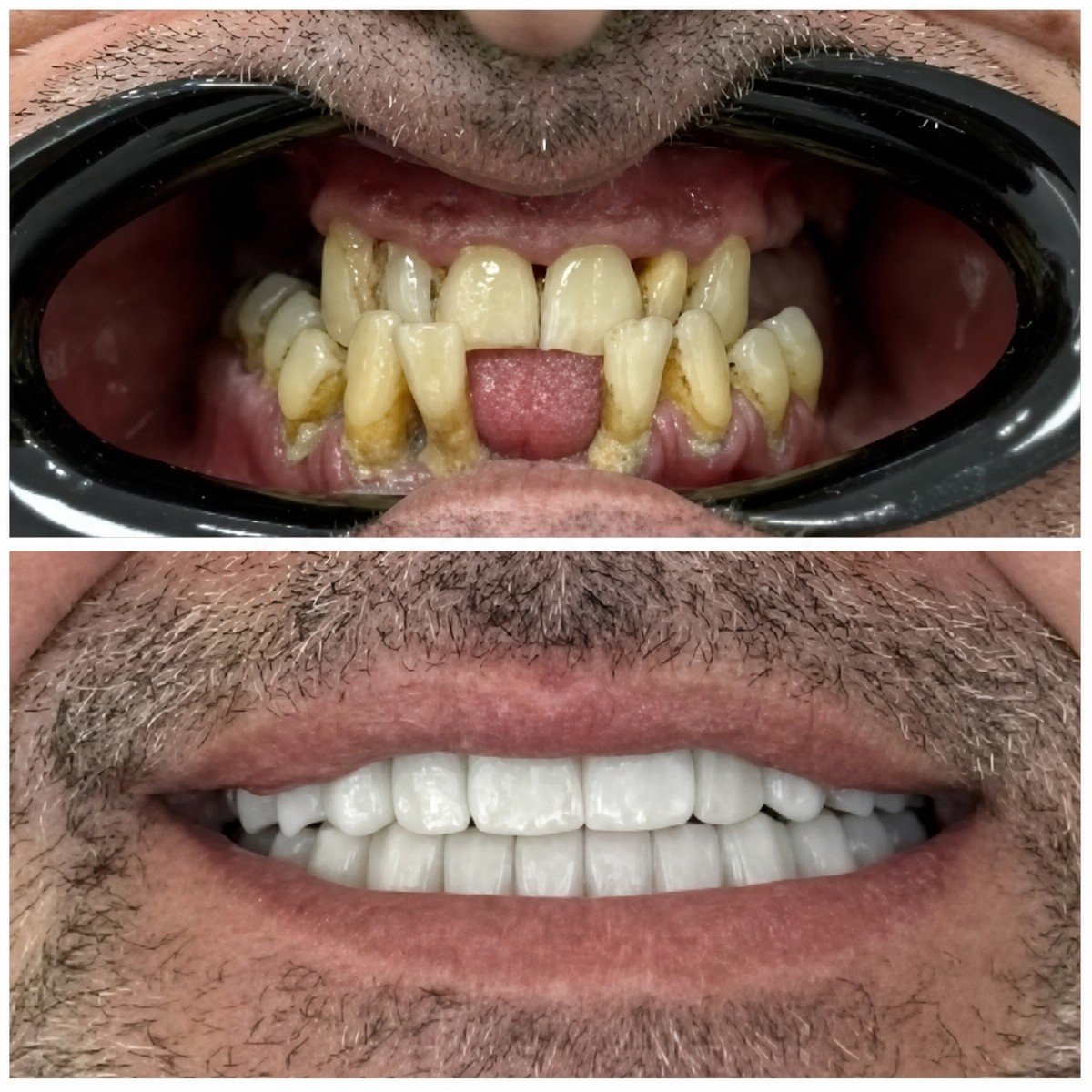 قبل وبعد تركيب تيجان الأسنان في عيادة سانتا كاترينا، نتيجة استعادة الابتسامة