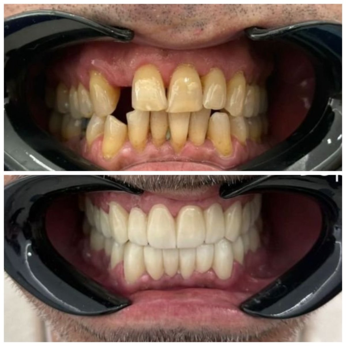 نتيجة قبل وبعد تركيب تيجان الأسنان في Santa Caterina Clinic Dental & Aesthetic Medicine