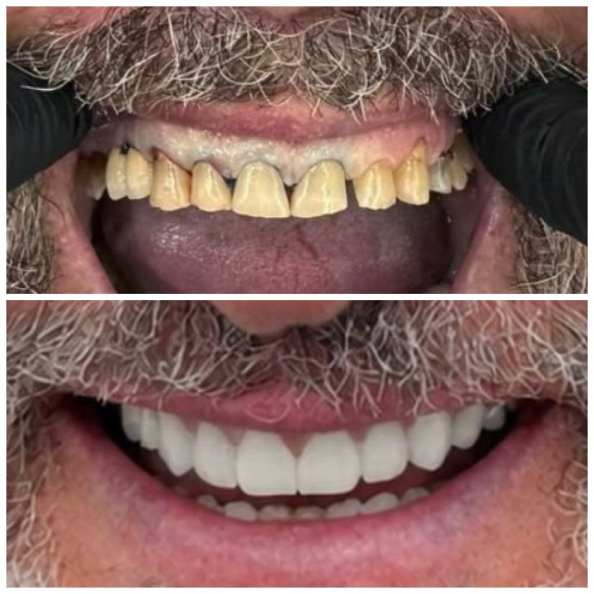 Resultados antes y después de la colocación de coronas dentales en Santa Caterina Clinic Dental & Aesthetic Medicine