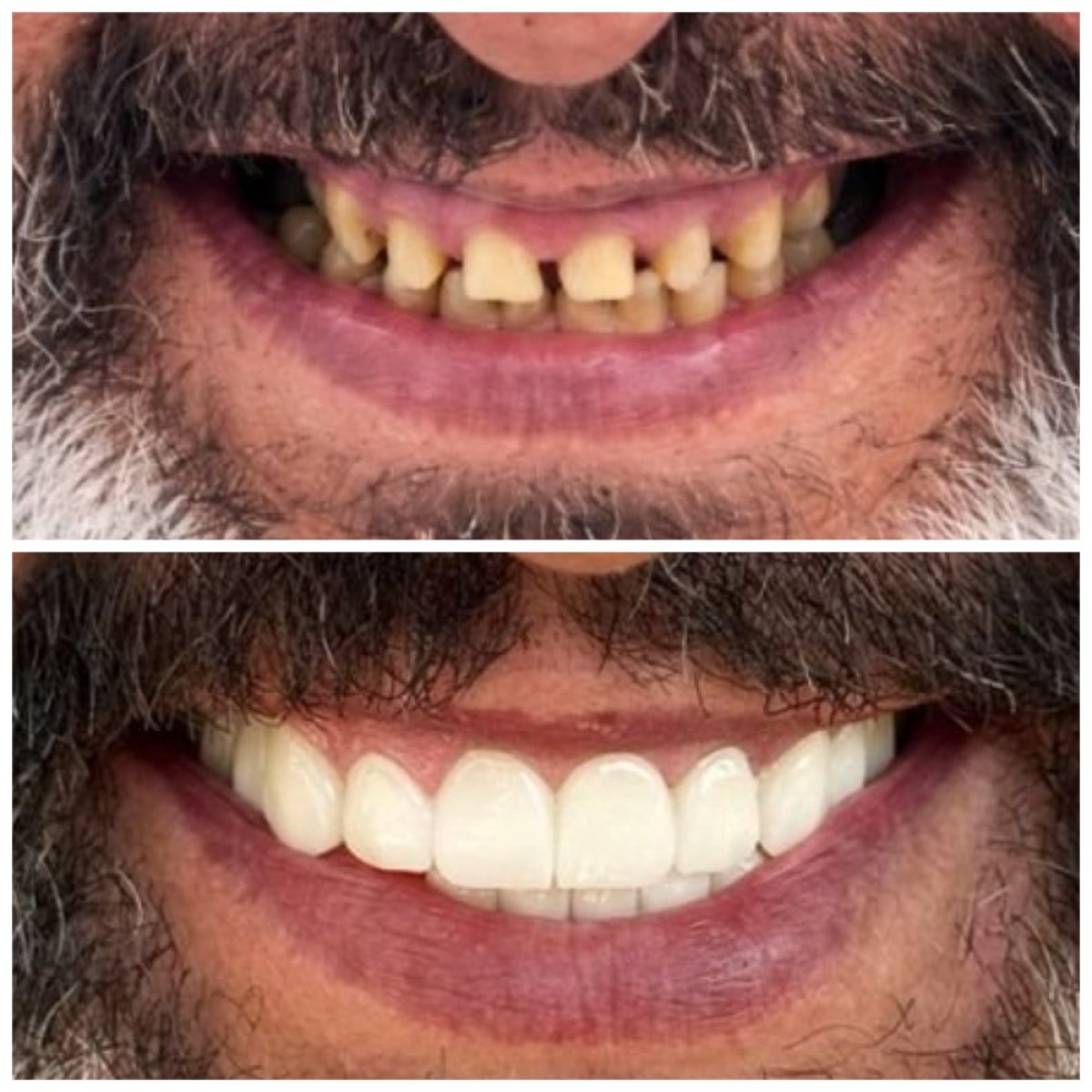 Before and after dental crown installation at Santa Caterina Clinic Dental & Aesthetic Medicine
