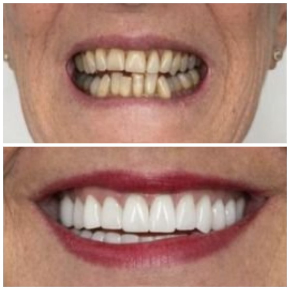 Résultat avant et après pose de couronnes dentaires à Santa Caterina Clinic Dental & Aesthetic Medicine