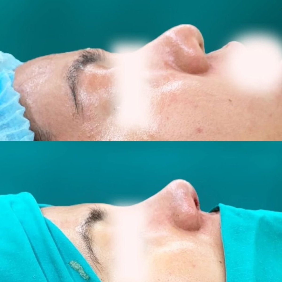 Résultats avant et après rhinoplastie à Munare Clinic Chiangmai, profil du nez amélioré