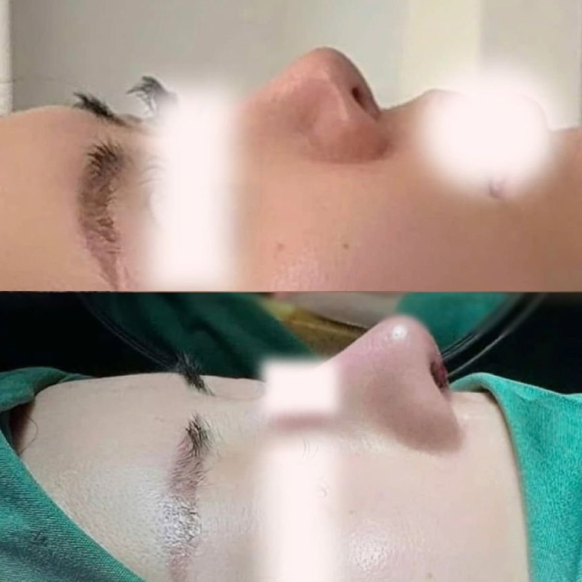 Resultados de rinoplastia antes y después en Munare Clinic Chiangmai, remodelación nasal