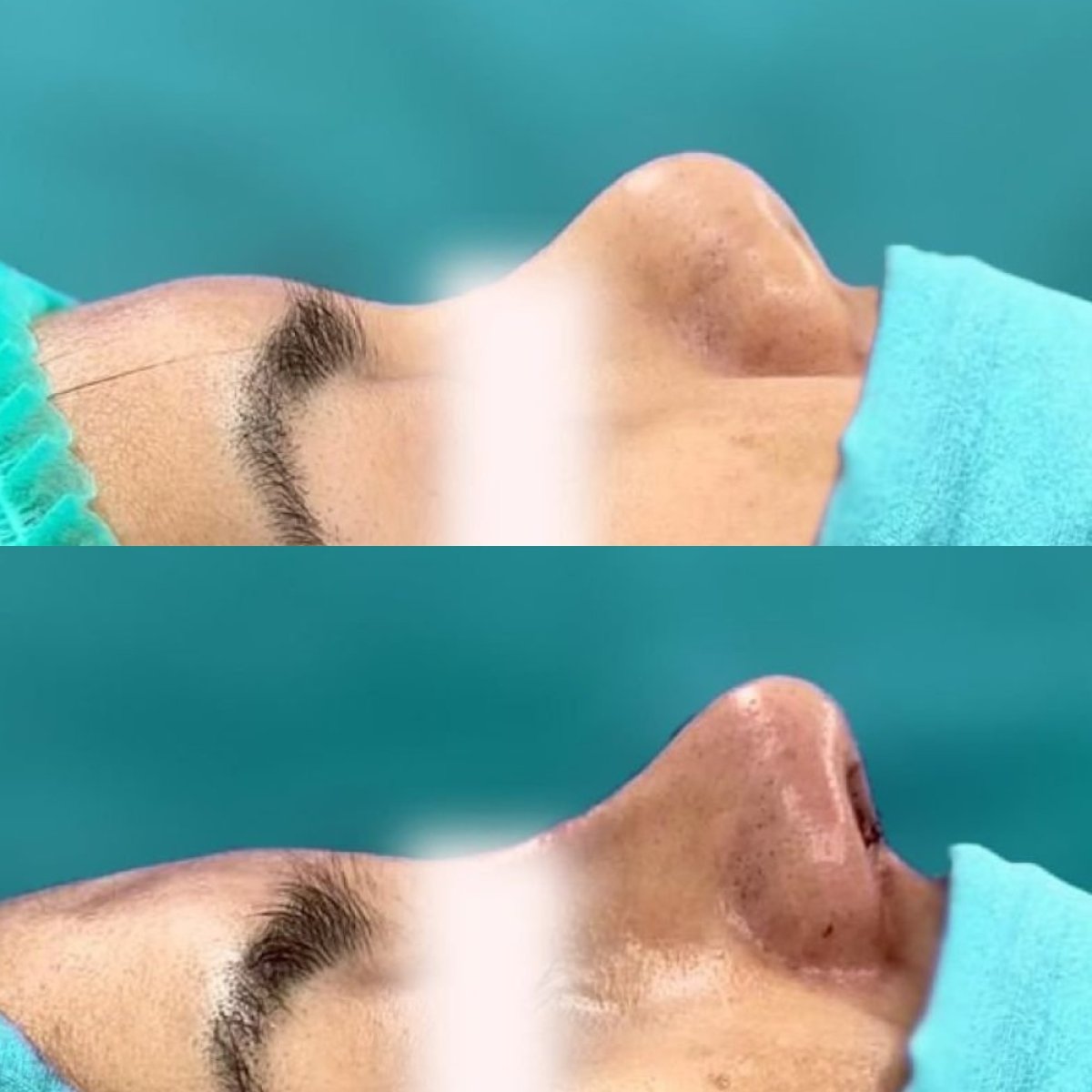 Résultat avant et après rhinoplastie à Munare Clinic Chiangmai, profil du nez amélioré