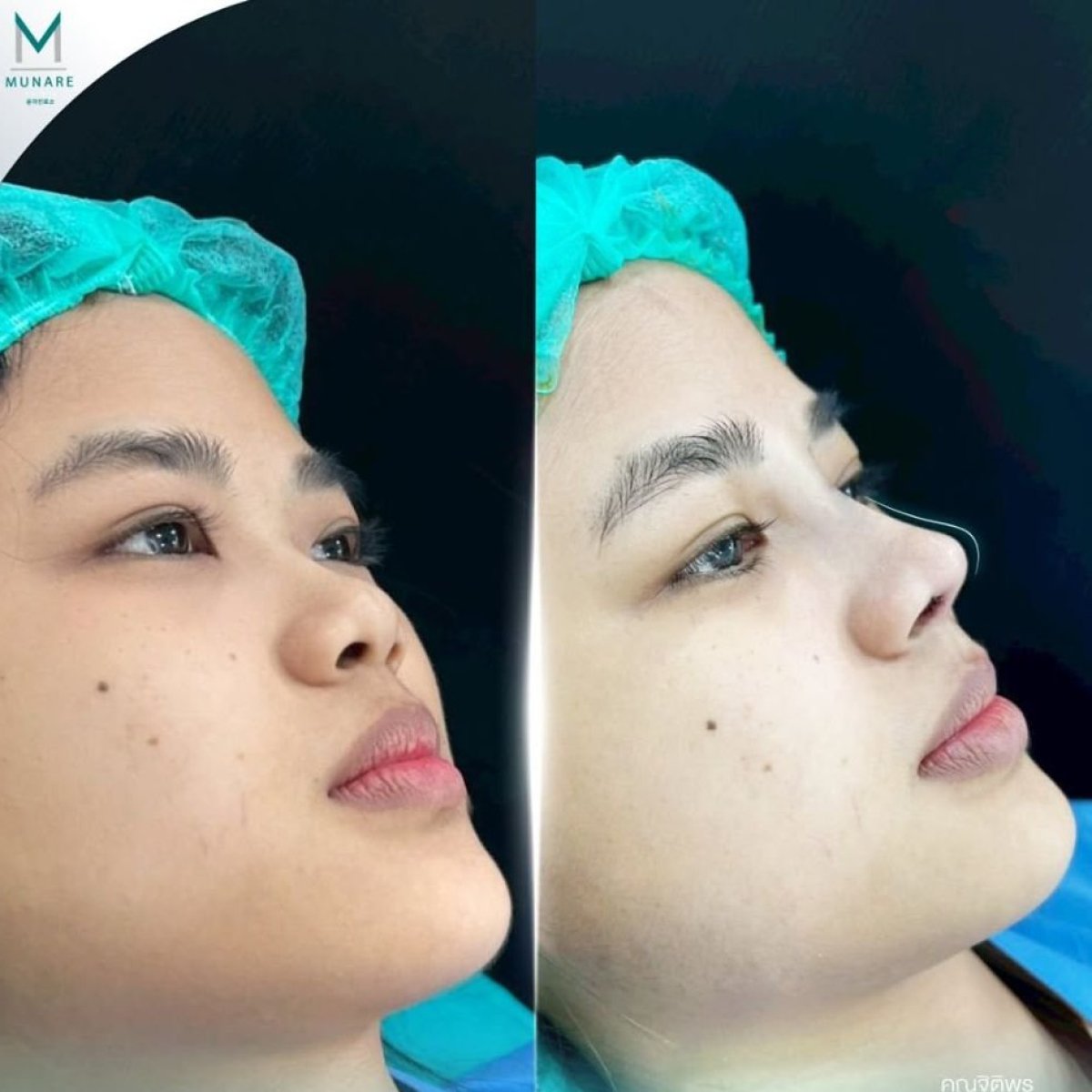 Resultados de rinoplastia antes y después en Munare Clinic Chiangmai, mejora de la nariz