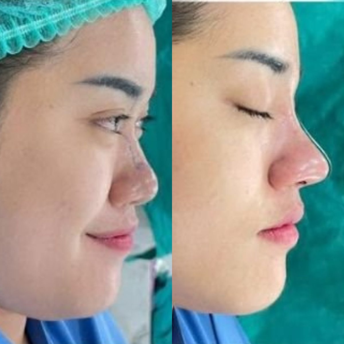 Resultados de rinoplastia antes y después en Munare Clinic Chiangmai, perfil nasal mejorado