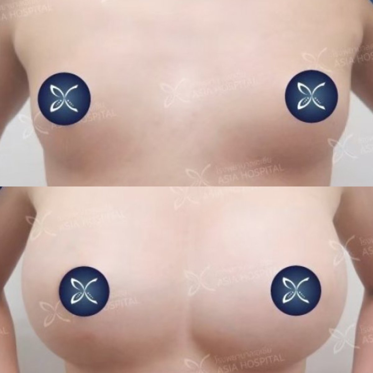 Before and after breast augmentation results at Asia Cosmetic Hospital, enhanced breast volume