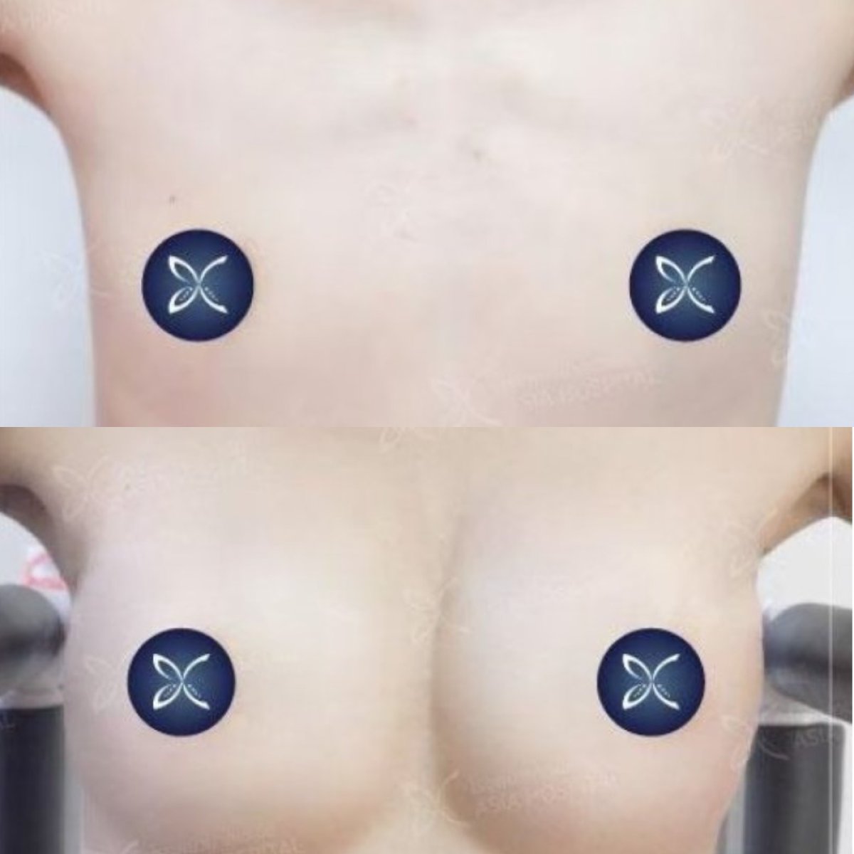 Before and after breast augmentation results at Asia Cosmetic Hospital, enhanced breast volume