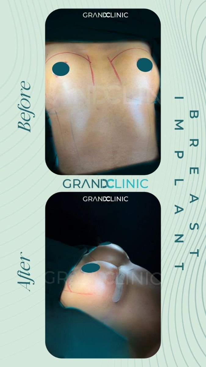 Résultats avant et après implants mammaires à Grand Clinic – forme et volume améliorés