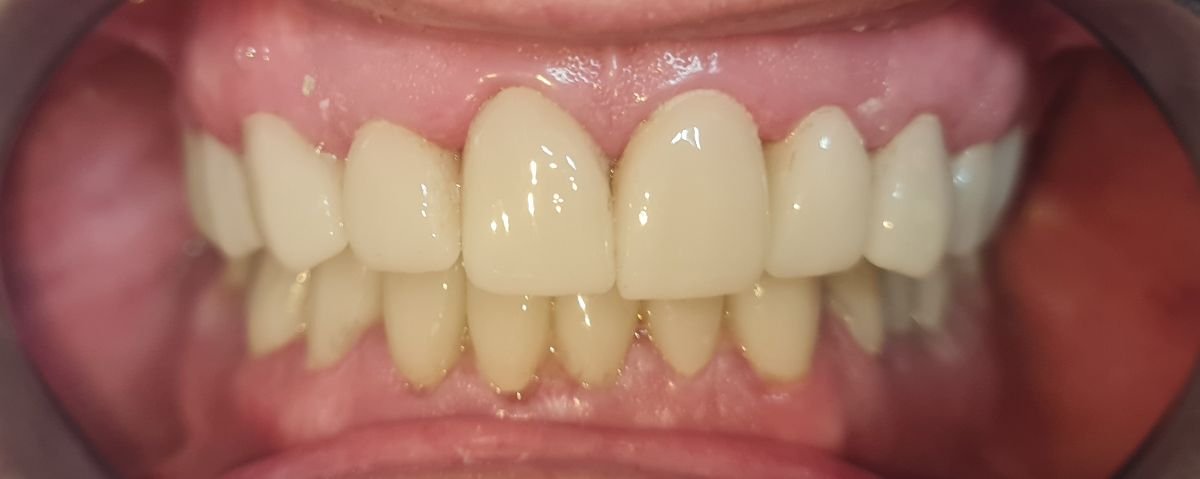 نتيجة تركيب تيجان الأسنان في SoftDentalCare Clinic – ابتسامة ومظهر أسنان محسّن