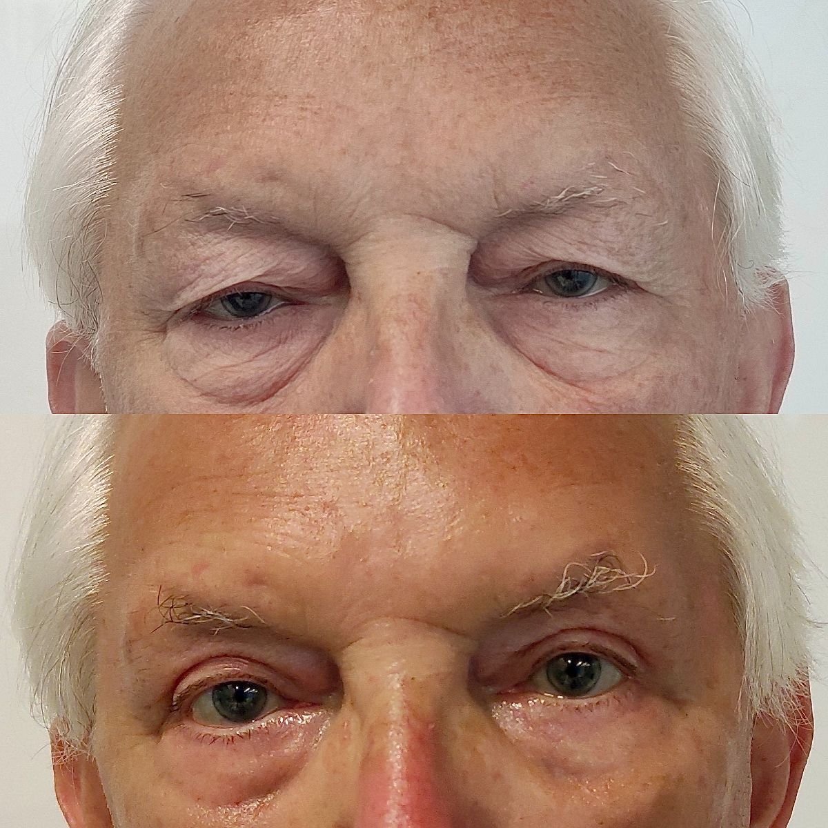 Resultados de blefaroplastia superior antes y después en Radzikowska Clinic, ojos mejorados