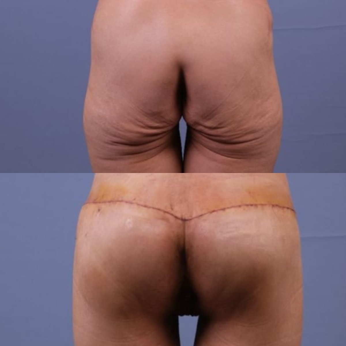 Résultats avant/après lifting du bas du corps à la clinique Dr. Safa Manav, contour amélioré