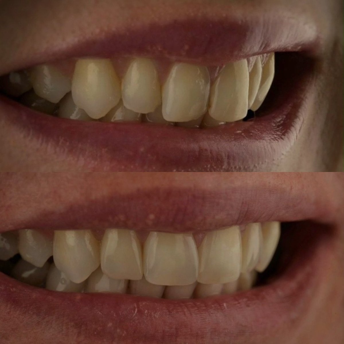 Resultados de antes y después de bonding dental en RIKOTA Dental Clinic para mejorar la sonrisa