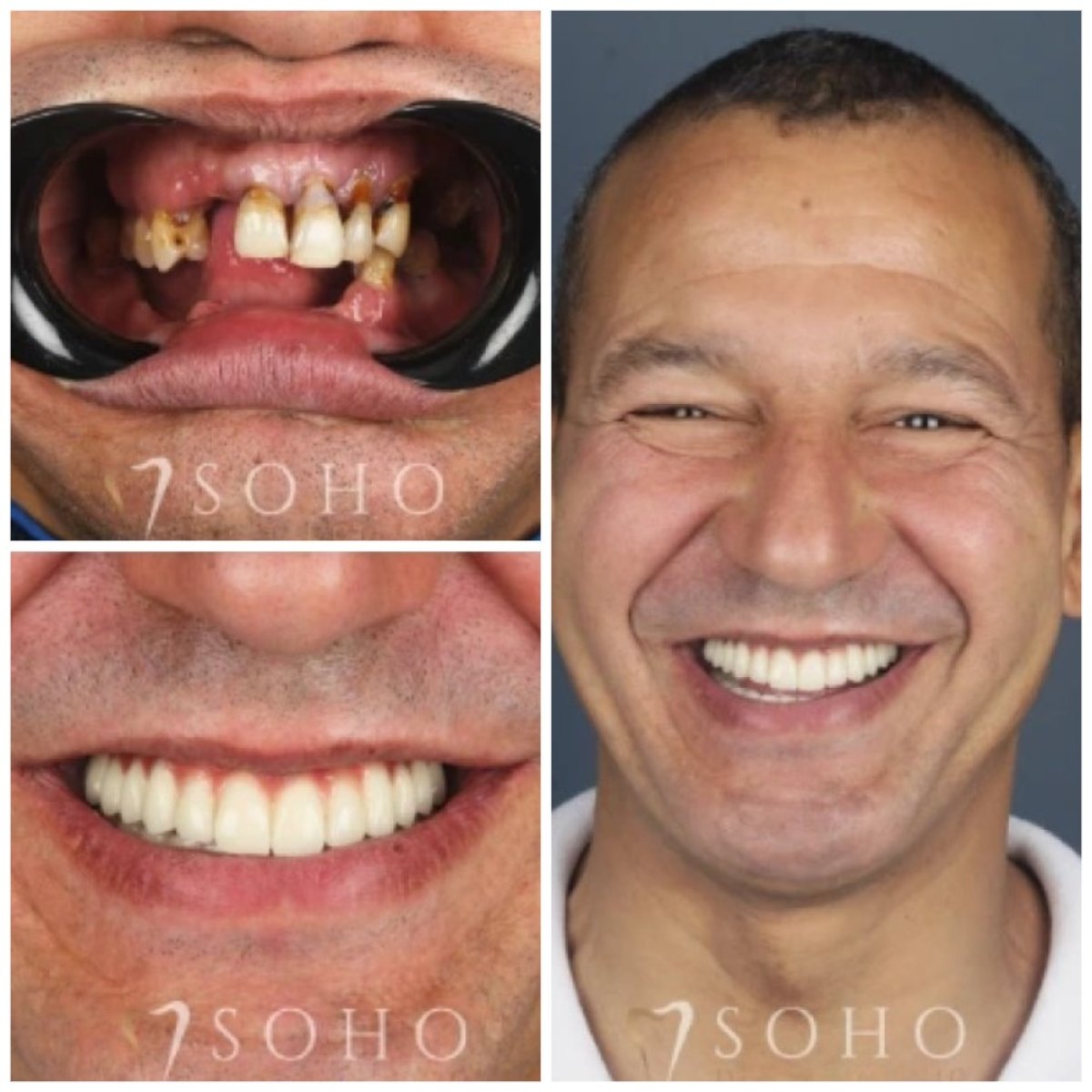 Before and after All-on-4 dental implants result at Soho Clinic – full smile restoration
