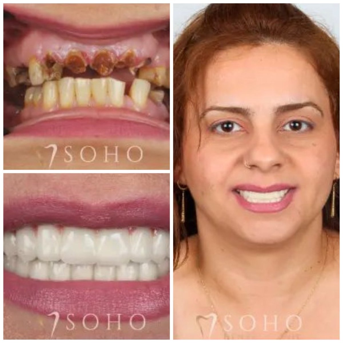 Before and after All-on-6 dental implants at Soho Clinic – full smile restoration result