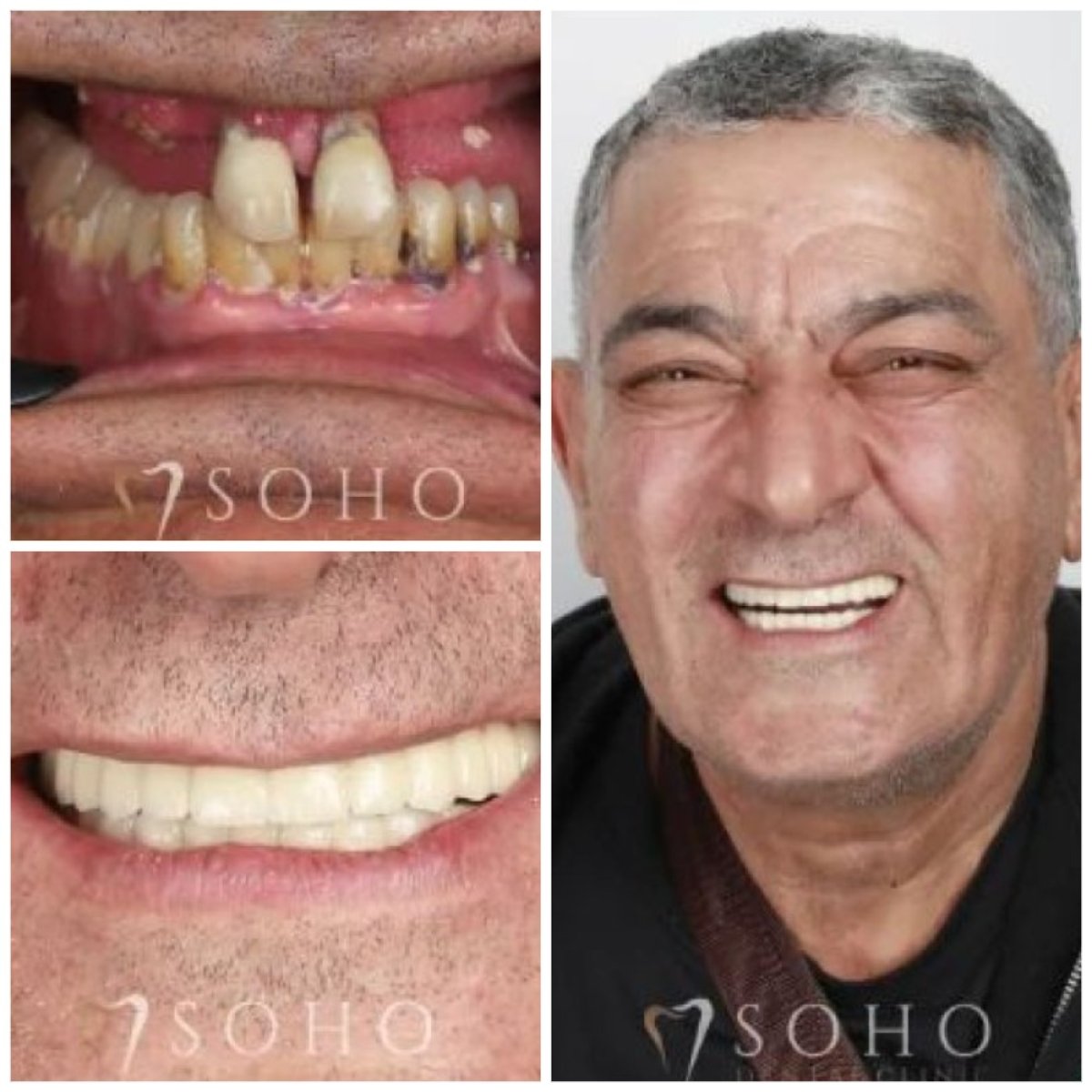 نتيجة زراعة الأسنان All-on-6 قبل وبعد في عيادة Soho – استعادة الابتسامة الكاملة