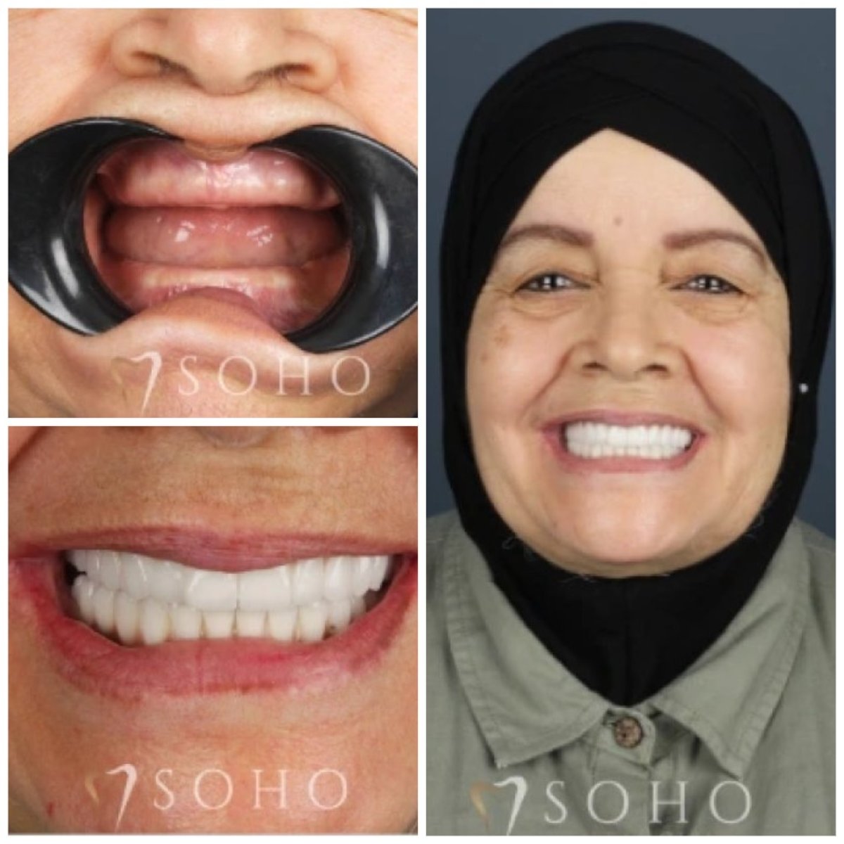 All-on-6 dental implants before and after results at Soho clinic – full smile restoration