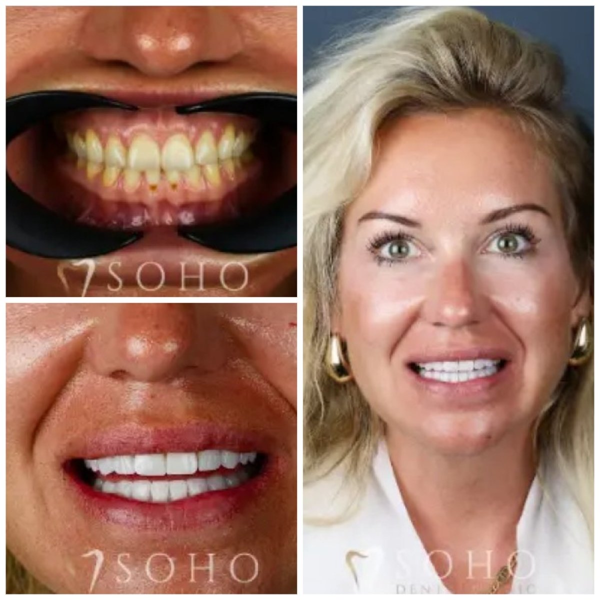 Avant et après facettes dentaires à Soho Dental Clinic – sourire transformé, dents blanches
