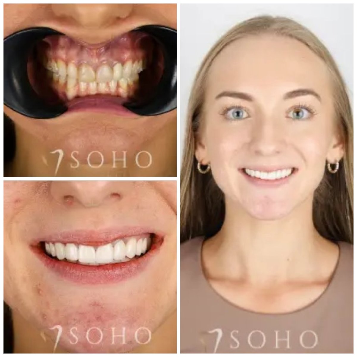 Before and after veneers at Soho clinic – smile transformation and whiter teeth result