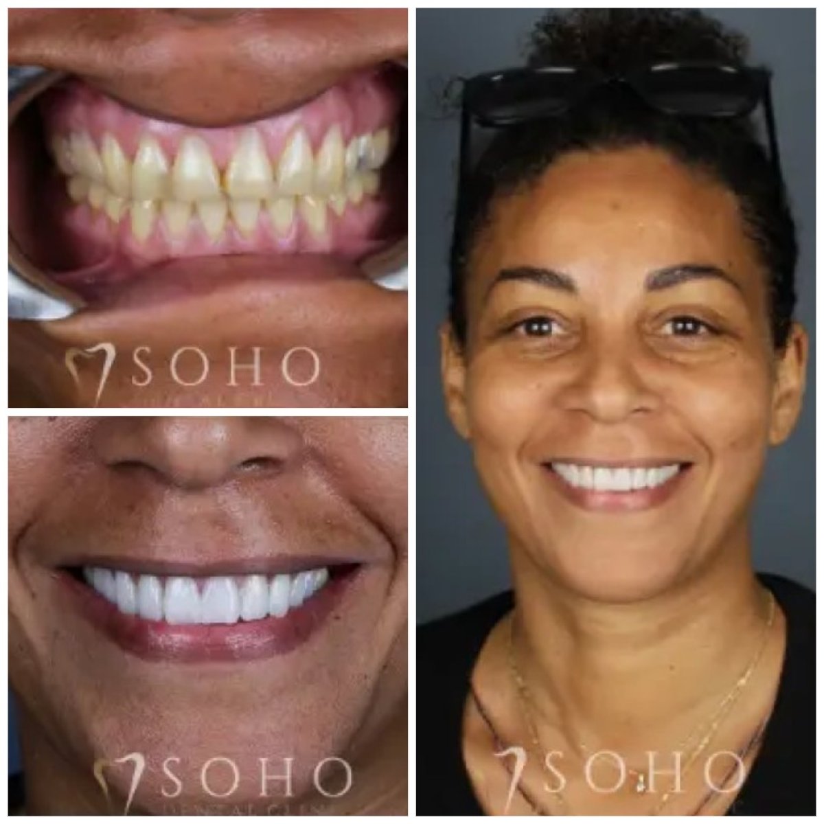 Przed i po licówkach w Soho Dental Clinic – metamorfoza uśmiechu i bielsze zęby