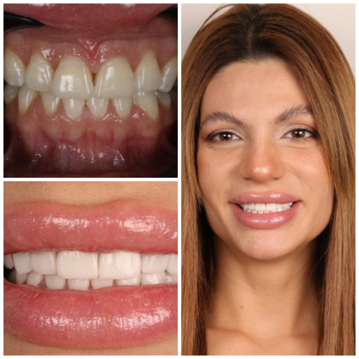 Before and after veneers result – smile makeover with dental veneers, visible teeth improvement