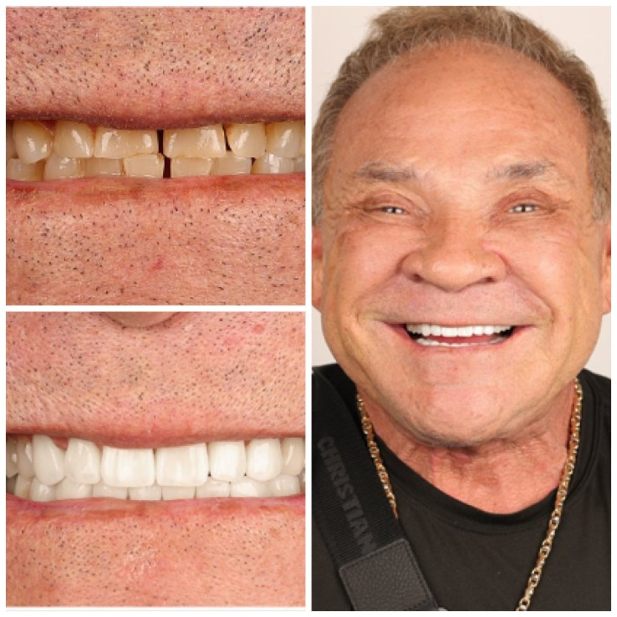 Before and after veneers result – smile makeover with whiter, even teeth