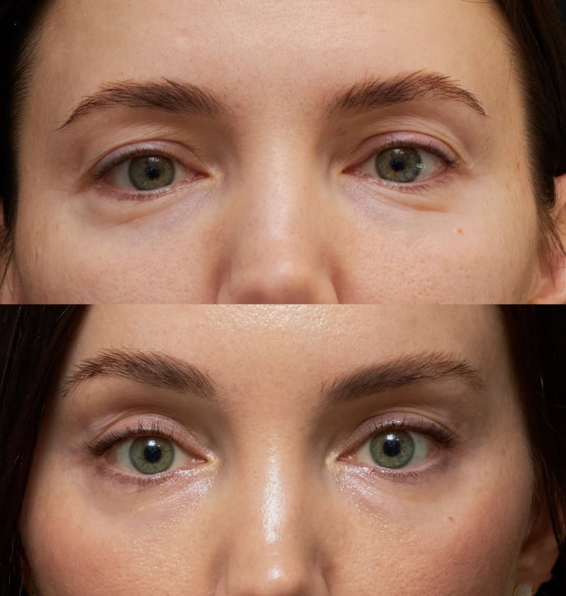 Before and after brow lift results at Vidnova Clinic – lifted brows and refreshed eye area
