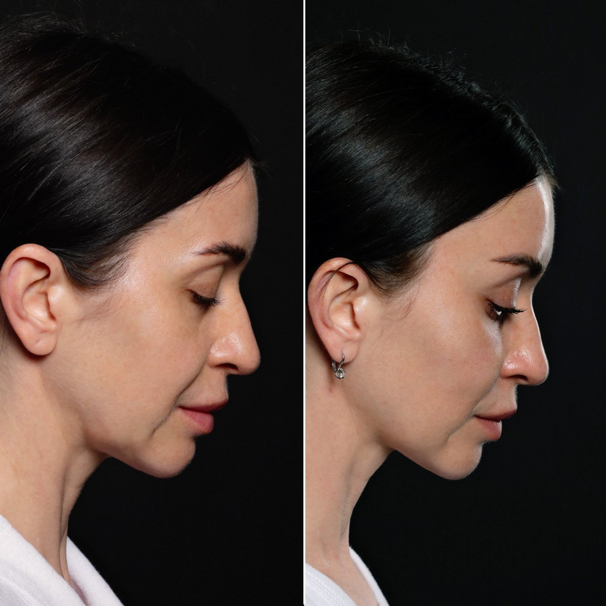 Resultados de lifting de cejas antes y después en Vidnova Clinic – rejuvenecimiento visible