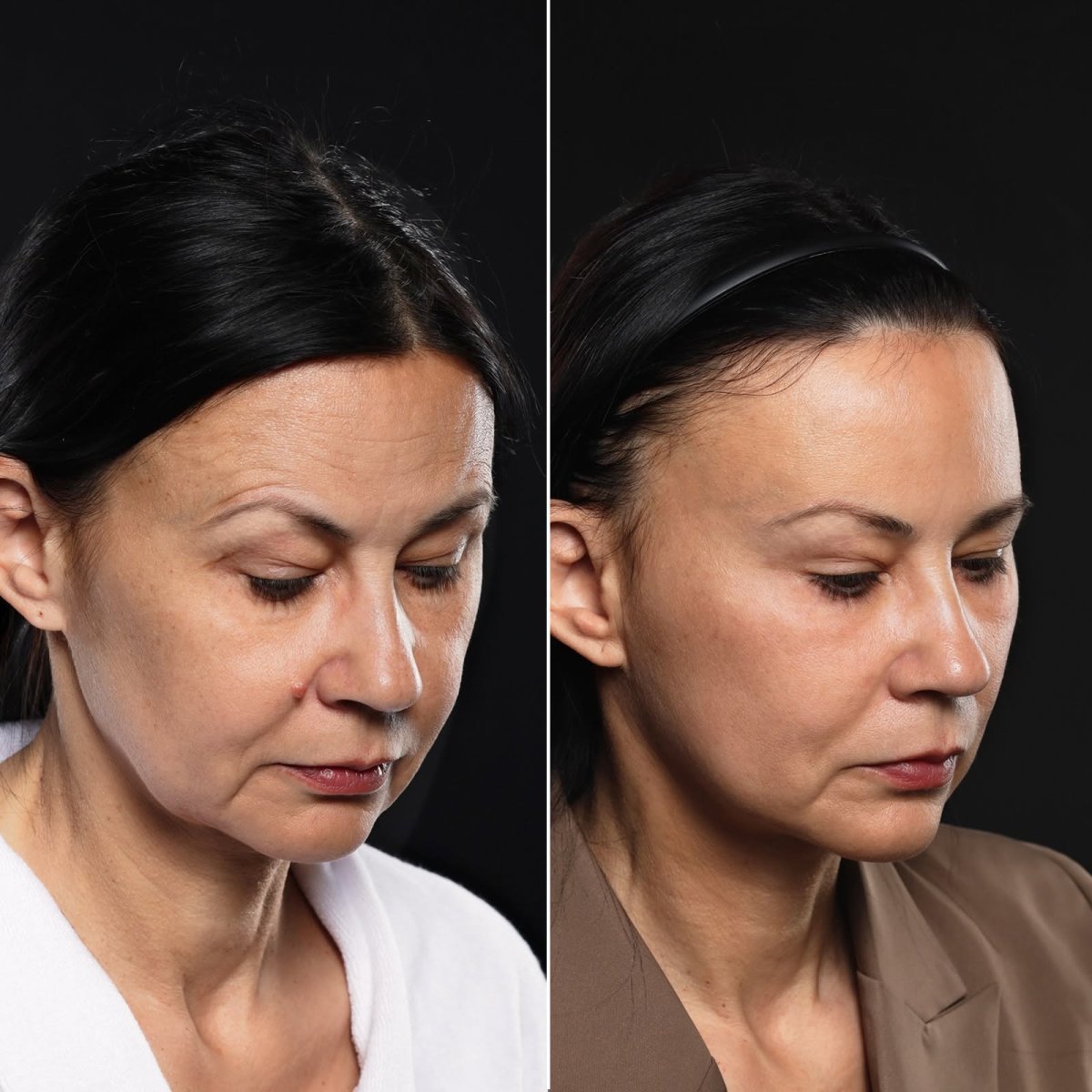 Resultados de lifting de cejas antes y después en Vidnova Clinic – rejuvenecimiento visible