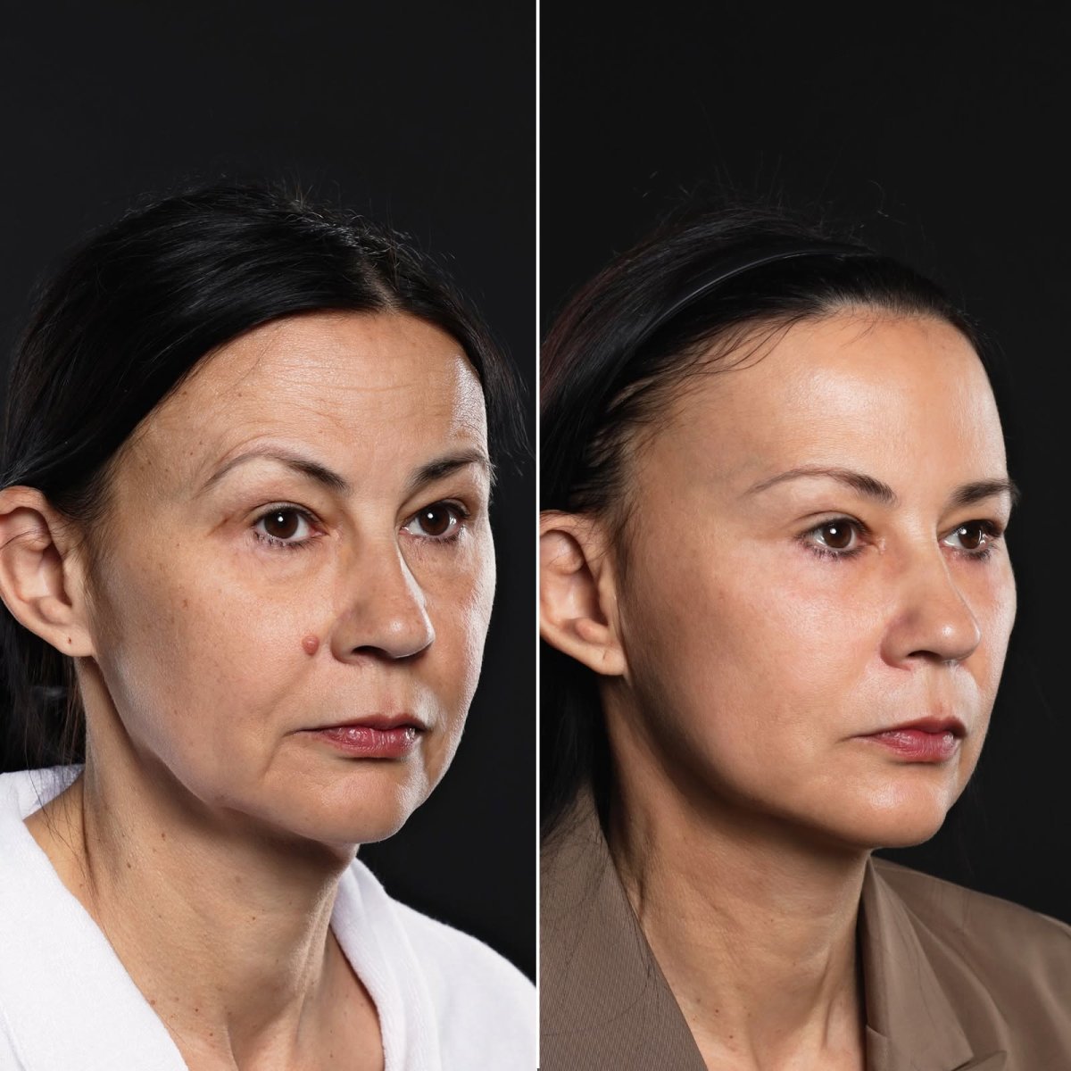 Resultados antes y después de lifting de cejas en Vidnova Clinic – cejas elevadas y frente lisa