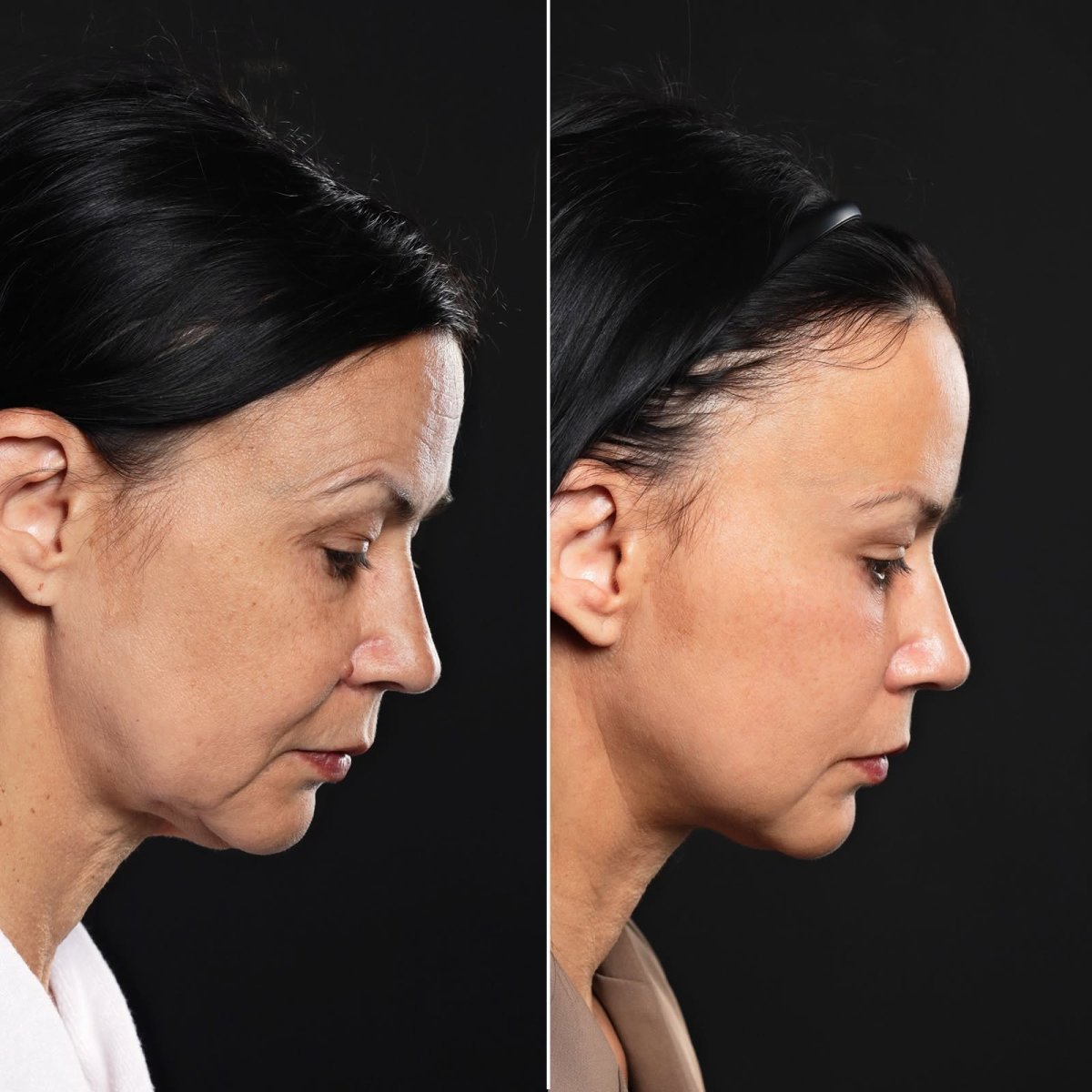Before and after brow lift results at Vidnova Clinic – visible forehead and brow rejuvenation
